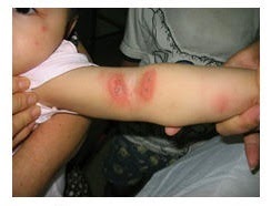 Trẻ bị viêm da do kiến ba khoang gia tăng