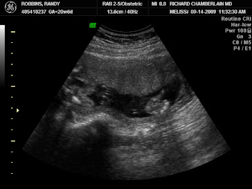 My baby boy giving a "thumbs-up" at 20 weeks.