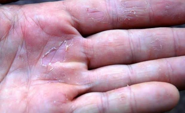 وهناك وصفتان لمنع تشقق اليدين وهناك وصفتان لمنع تشقق اليدين