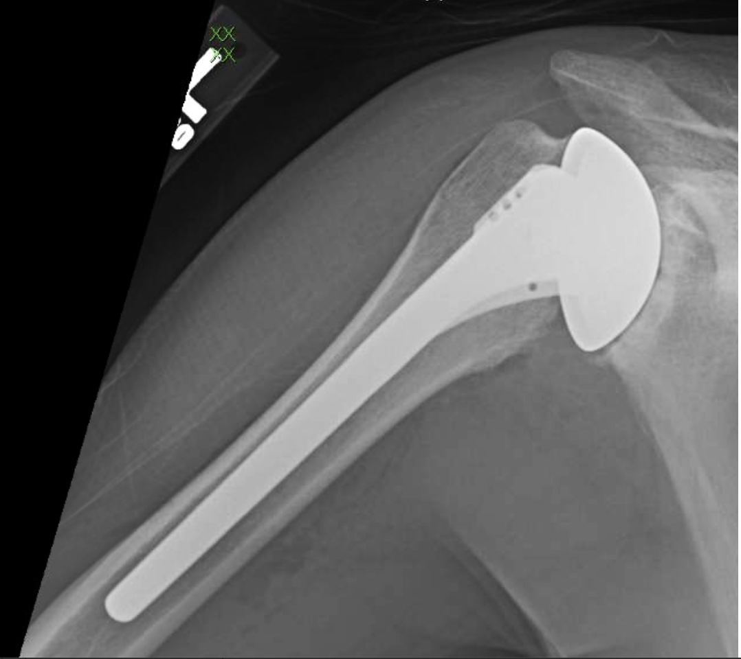 UW Shoulder and Elbow Academy Stemless humeral components what is