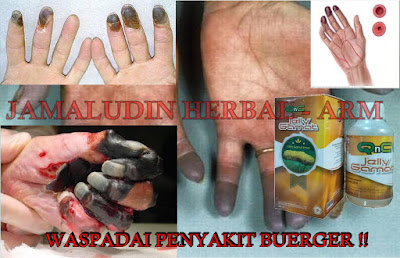 http://arumherbal30.blogspot.co.id/2018/03/obat-herbal-untuk-penyakit-buerger.html