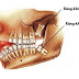 Vì sao răng khôn hàm dưới mọc lệch ra má?