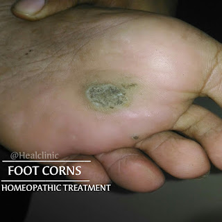 Foot corns homeopathy treatment 
