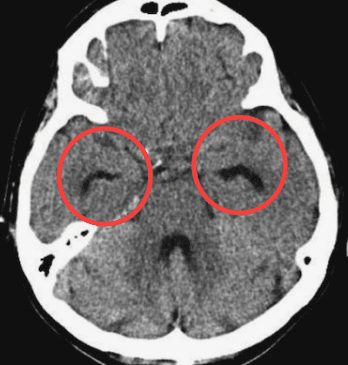 家庭医・医学教育研究者の省察的実践録: クモ膜下出血のnico-nico sign