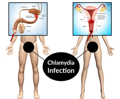 chlamydial disease
