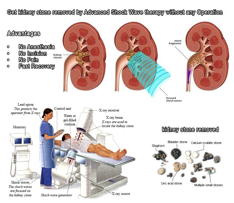 Extracorporeal Shock Wave Lithotripsy (E.S.W.L.) Biomedical