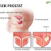 SUPLEMEN UNTUK MASALAH PROSTAT