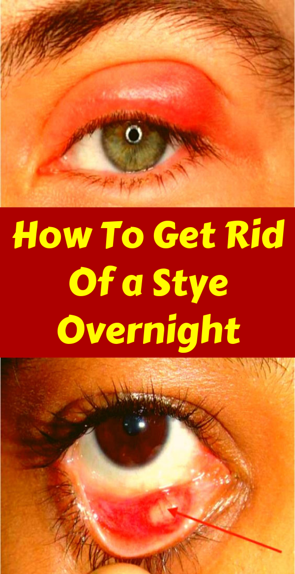 How To Get Rid Of a Stye Overnight