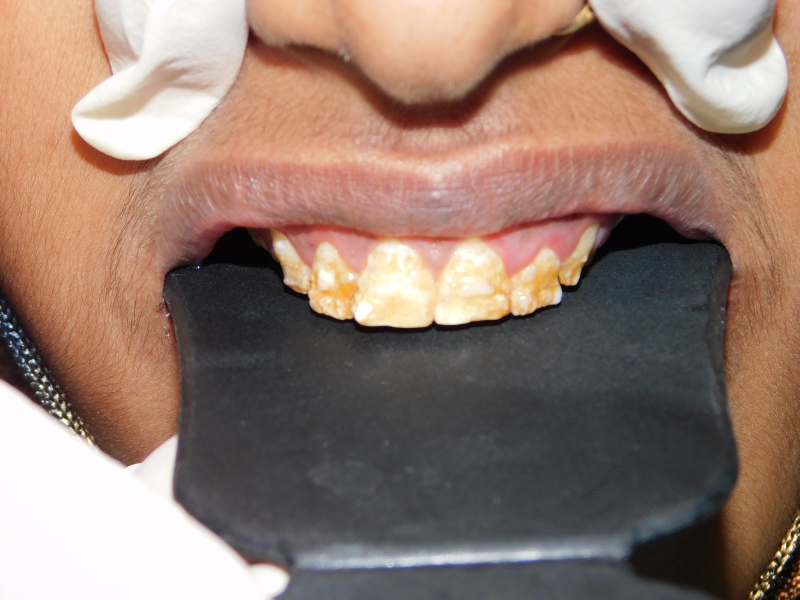 Aesthetic Rehabilitation of Young Female Patient with Congenital