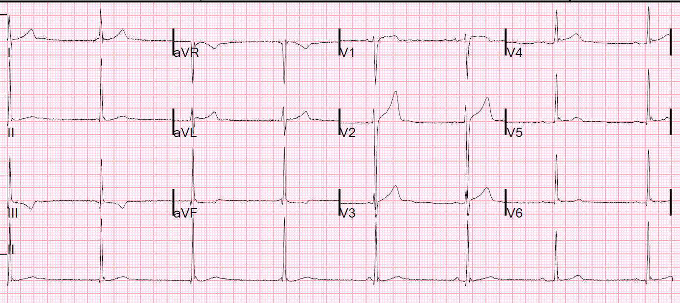 Sudden Deafness In One Ear Ringing Stats Sudden Deafness In One Ear Ringing Stats