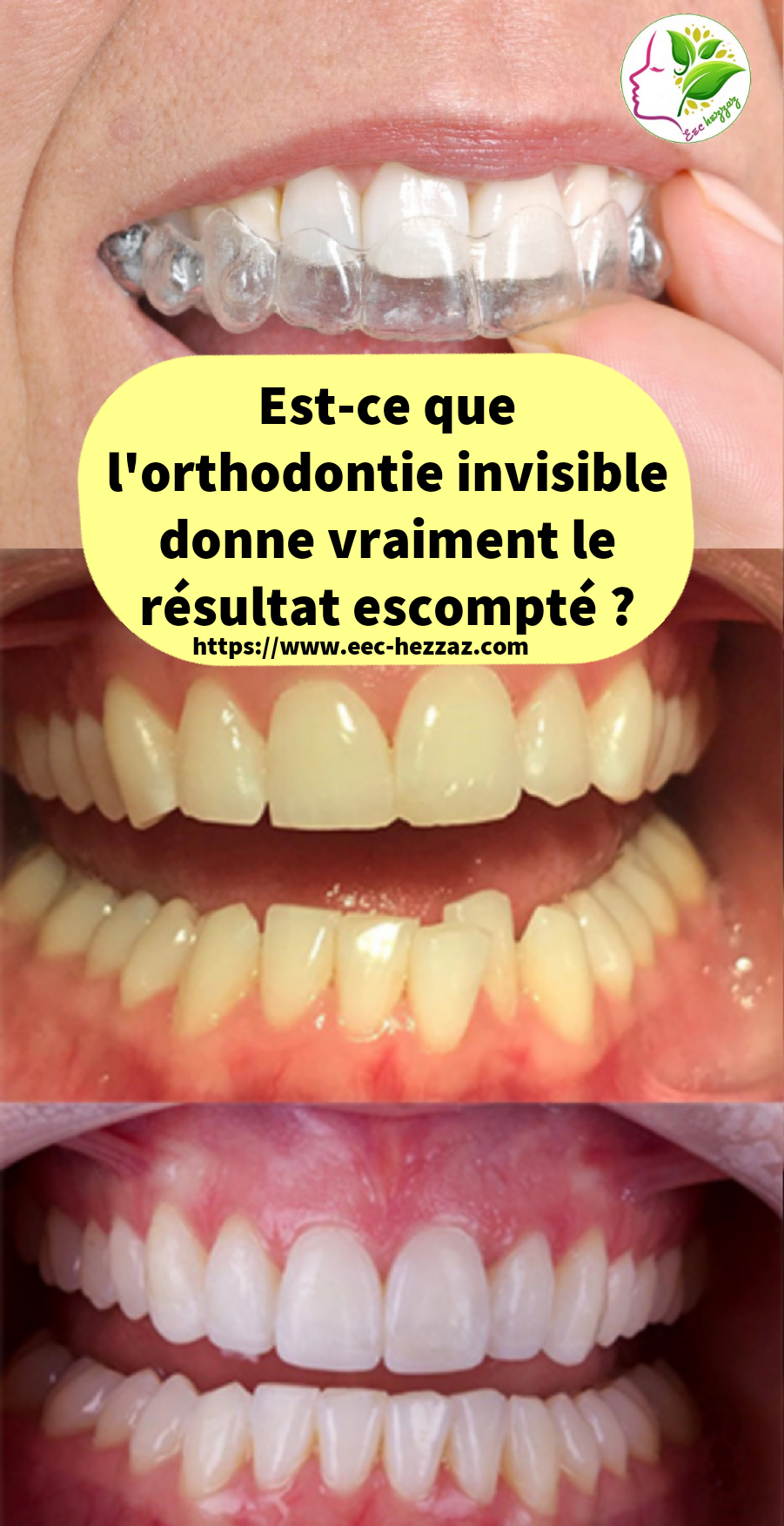 Est-ce que l'orthodontie invisible donne vraiment le résultat escompté ?