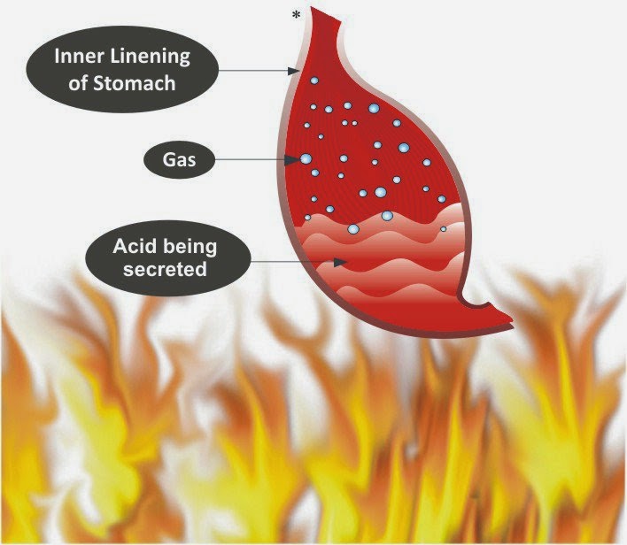 Acidity Definition,Symptoms of Acid,Treatment and Prevention Health Mania
