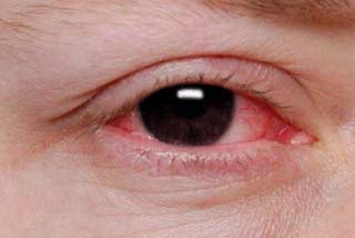 Penyebab Dan Cara Mengobati Mata Merah Dengan Benar