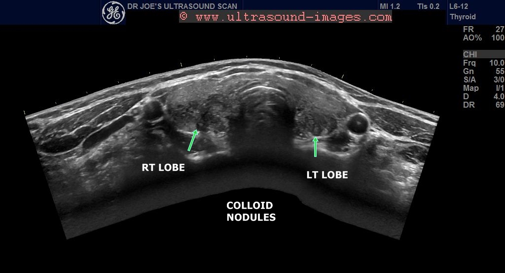 Ultrasound imaging Multiplecolloidnodulesthyroid