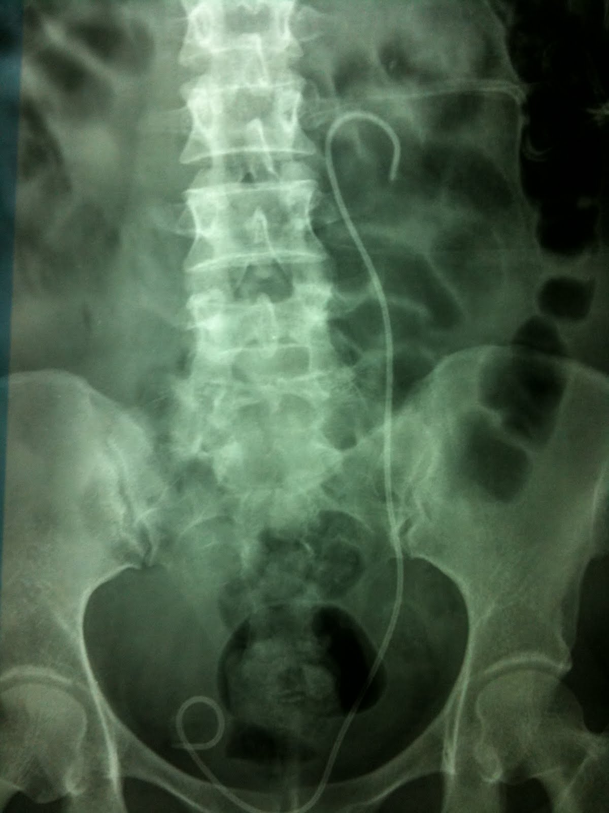 Ramayya Pramila Urology Hospital PCNL in a complete staghorn calculus