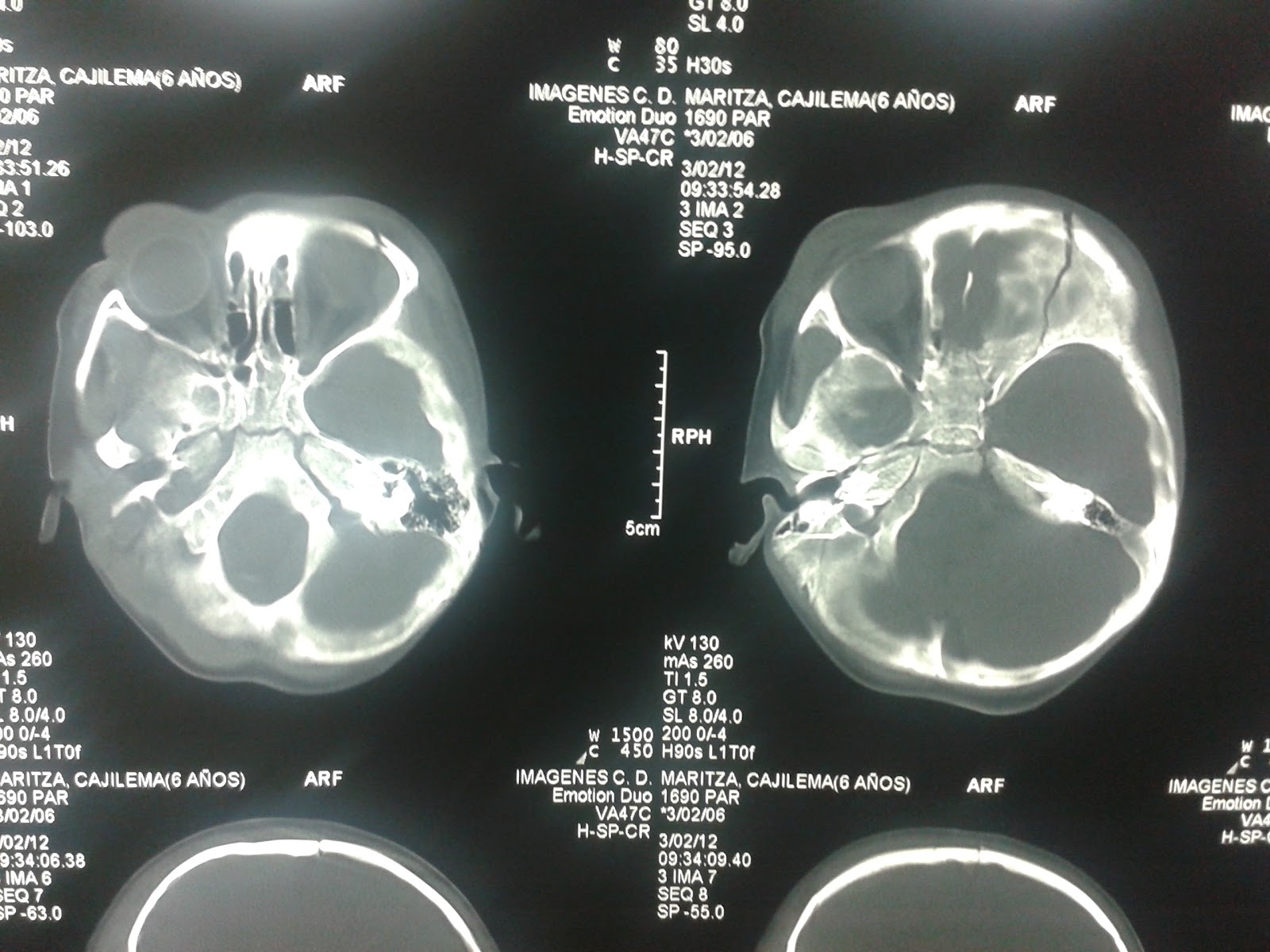 CEREBRA LA VIDA: APUNTES SOBRE TRAUMATISMOS CRANEOENCEFALICOS