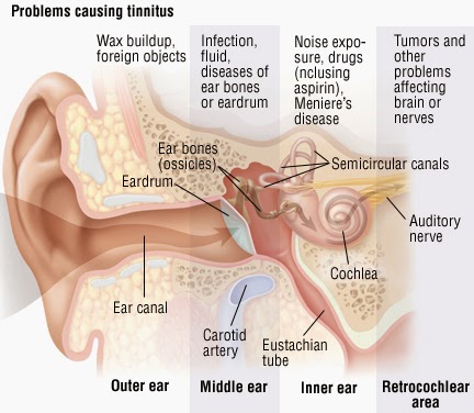 What causes tinnitus ringing in the ears