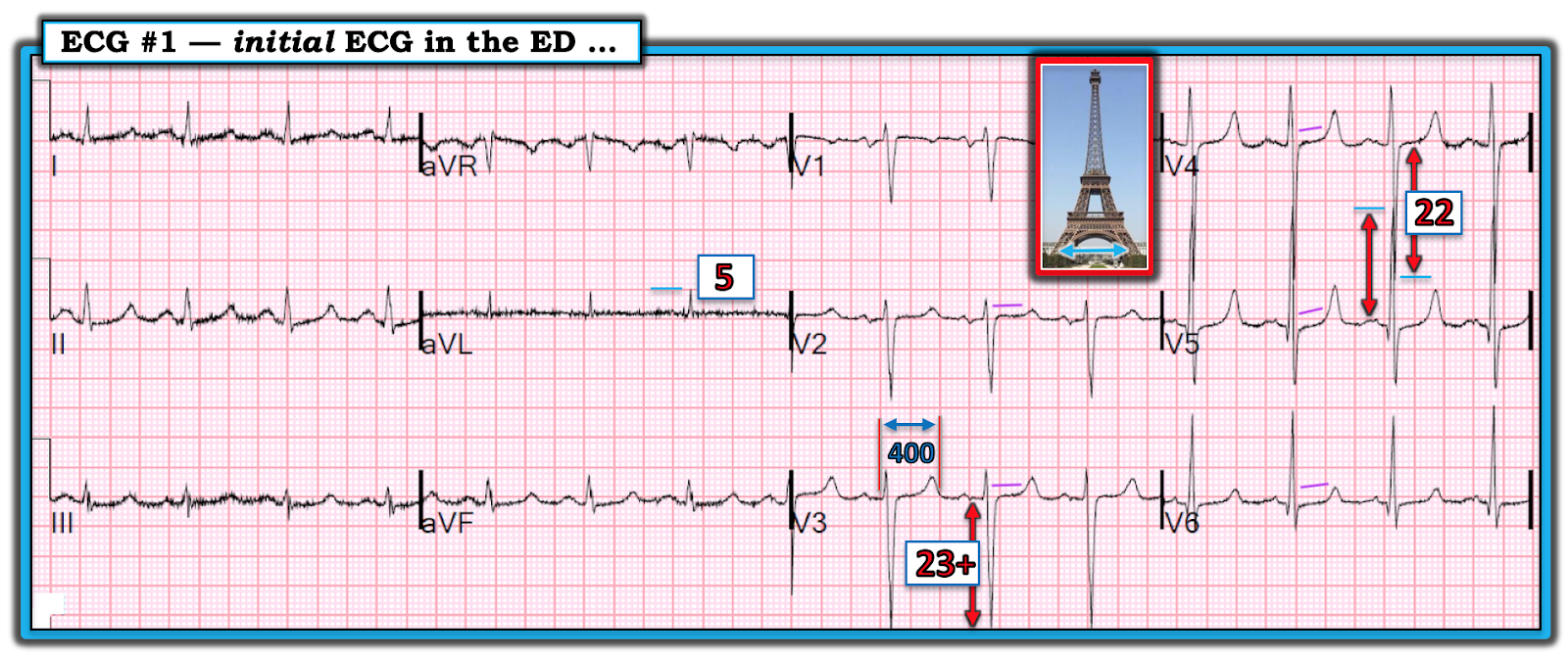 The initial ECG done in the ED (See text). 