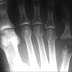 Acute Osteomyelitis: Etiology, pathogenesis