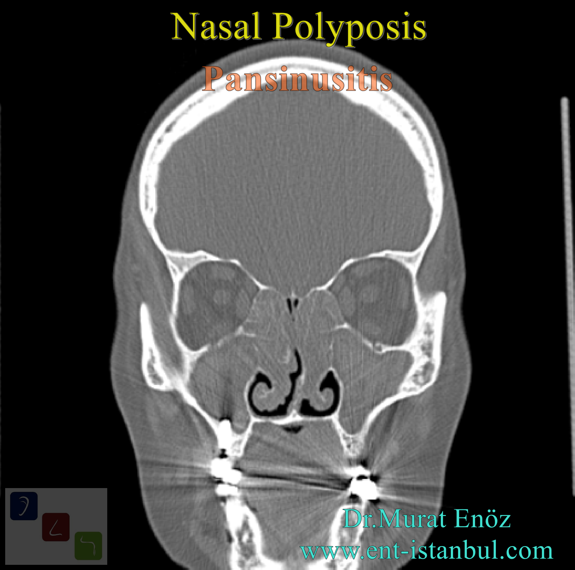 Nasal Polyp Definition, Symptoms, Diagnosis and Treatment