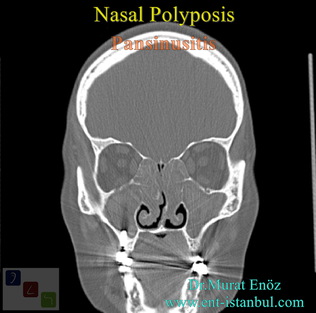 nasal polyposis pansinusitis