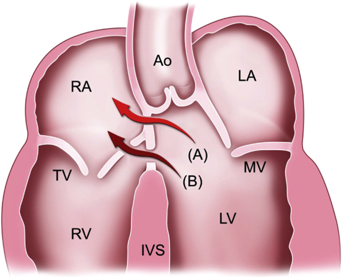 HealthforHeart Gerbode Ventricular Septal Defect