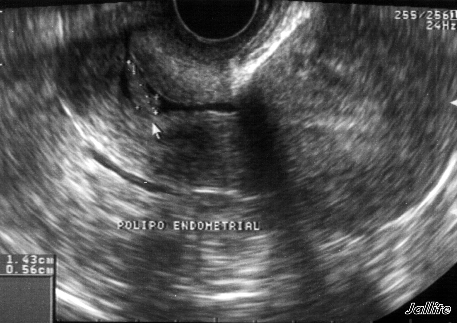 Polipo Endocervical & Apendicitis Polipo Endocervical & Apendicitis