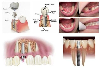 cay-ghep-rang-su-implant