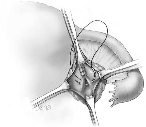 Ovarian Cystectomy surgery