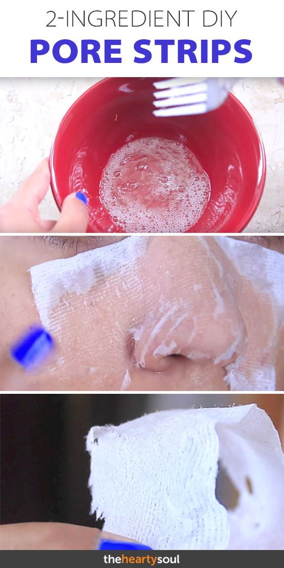 How to Get Rid of Blackheads Naturally (2Ingredient Recipe) Tips Dietz