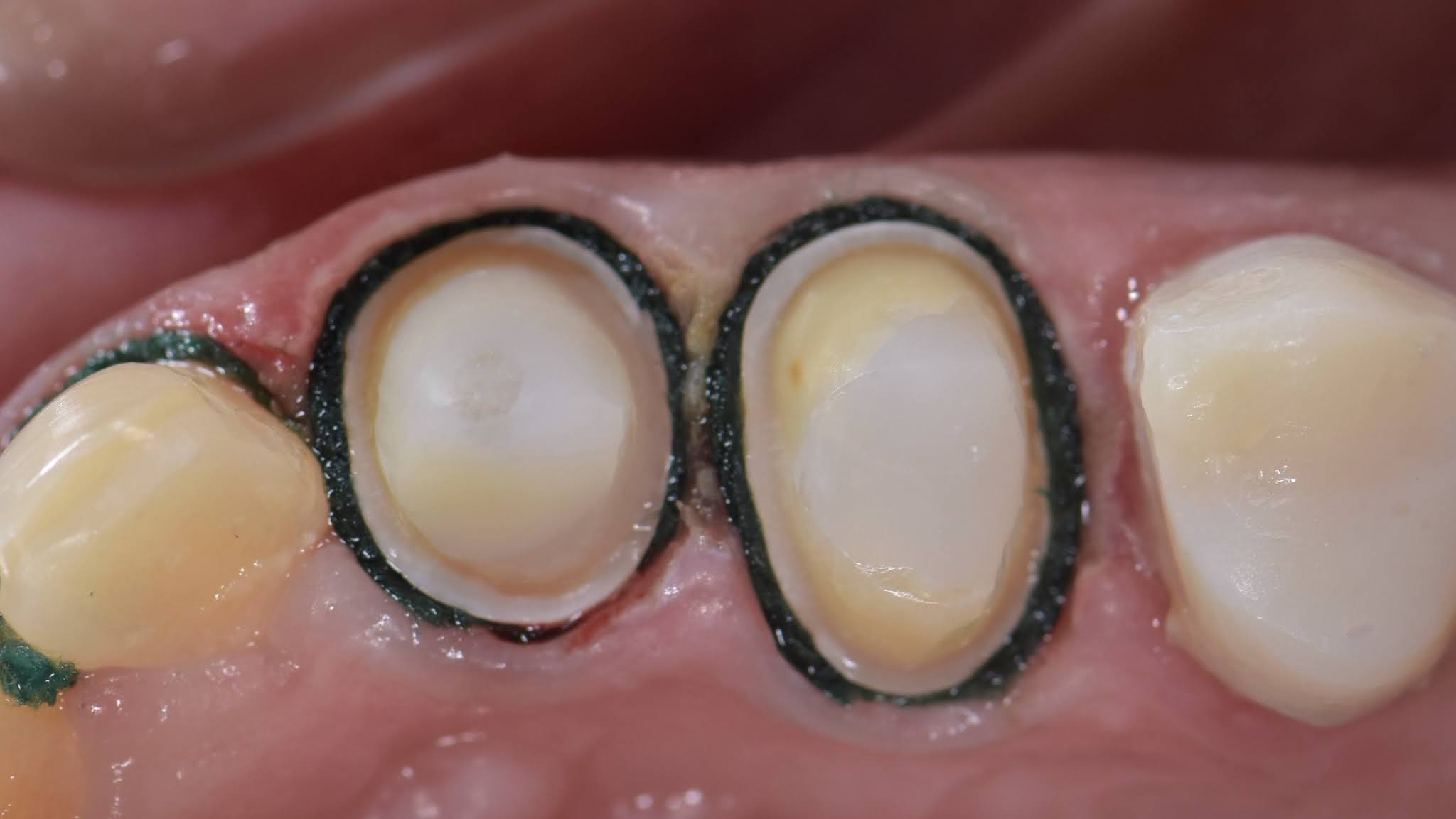 Retraction cords.. Why? When? How? Dental Esthetics