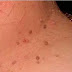 What causes Skin Tags, Prevention and Cure (Images)
