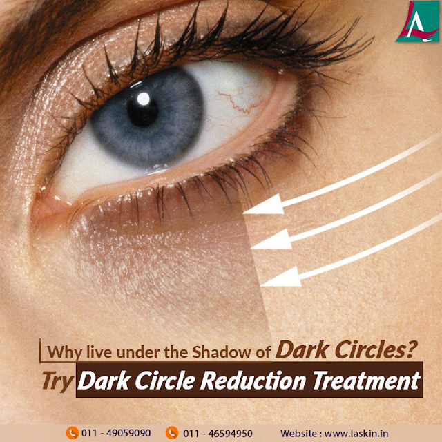 under eye dark circles treatment