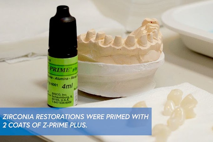 DENTAL MATERIALS: Full Arch Case using BISCO's Z-Prime Plus & TheraCem
