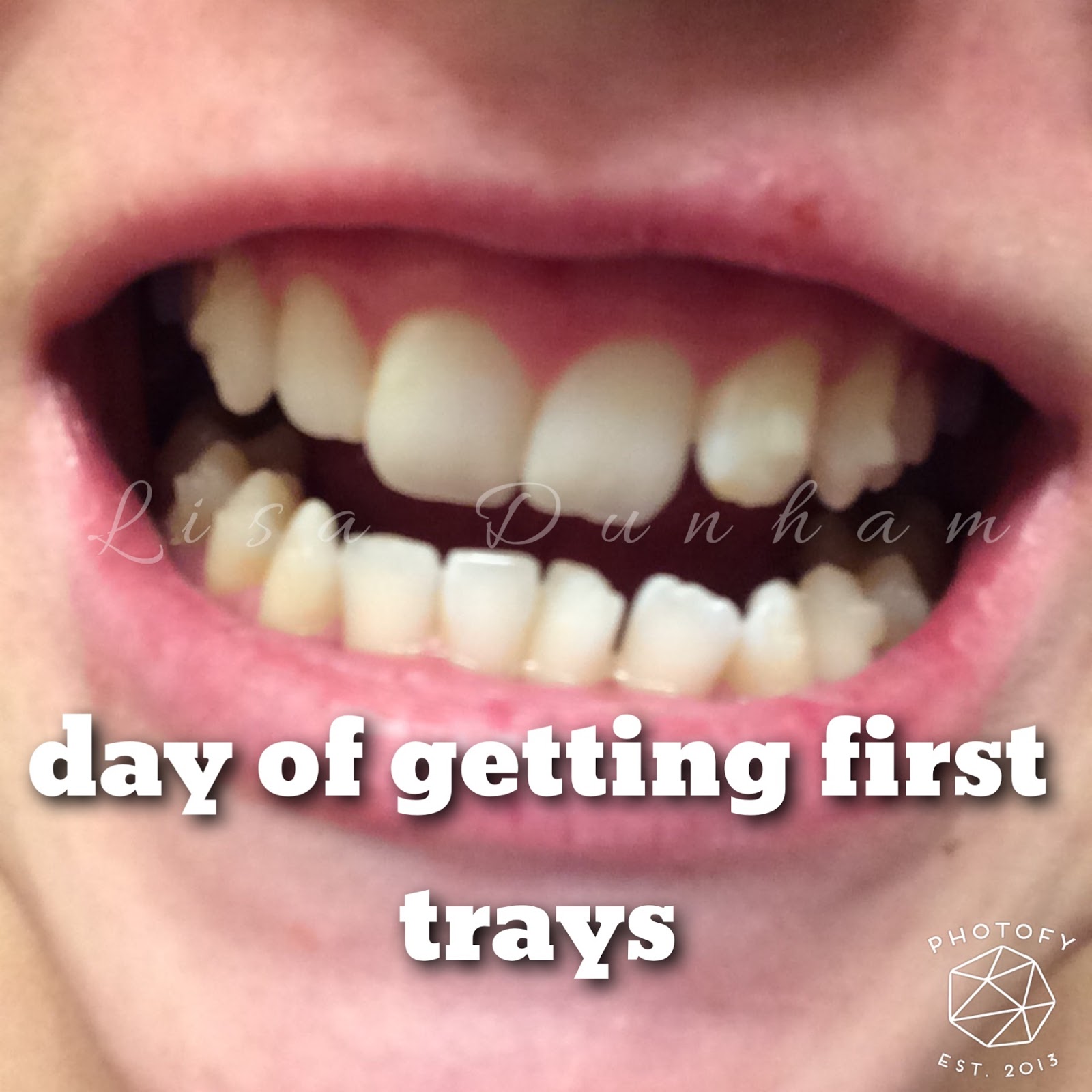 Dunham Wellness My First Invisalign Update of many, Tray 2 of 26!!