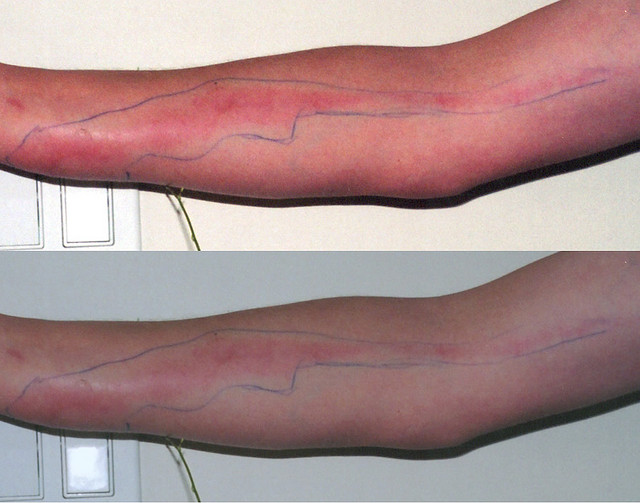 Methicillin-resistant Staphylococcus aureus (MRSA ...