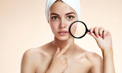 3 Top Acne Skin Care Tips For A Healthier Skin