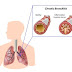 Acute and Chronic Bronchitis | causes, symptoms and management