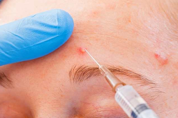 Inoculate Stubborn Acne Acne to Fix, Is It Dangerous?