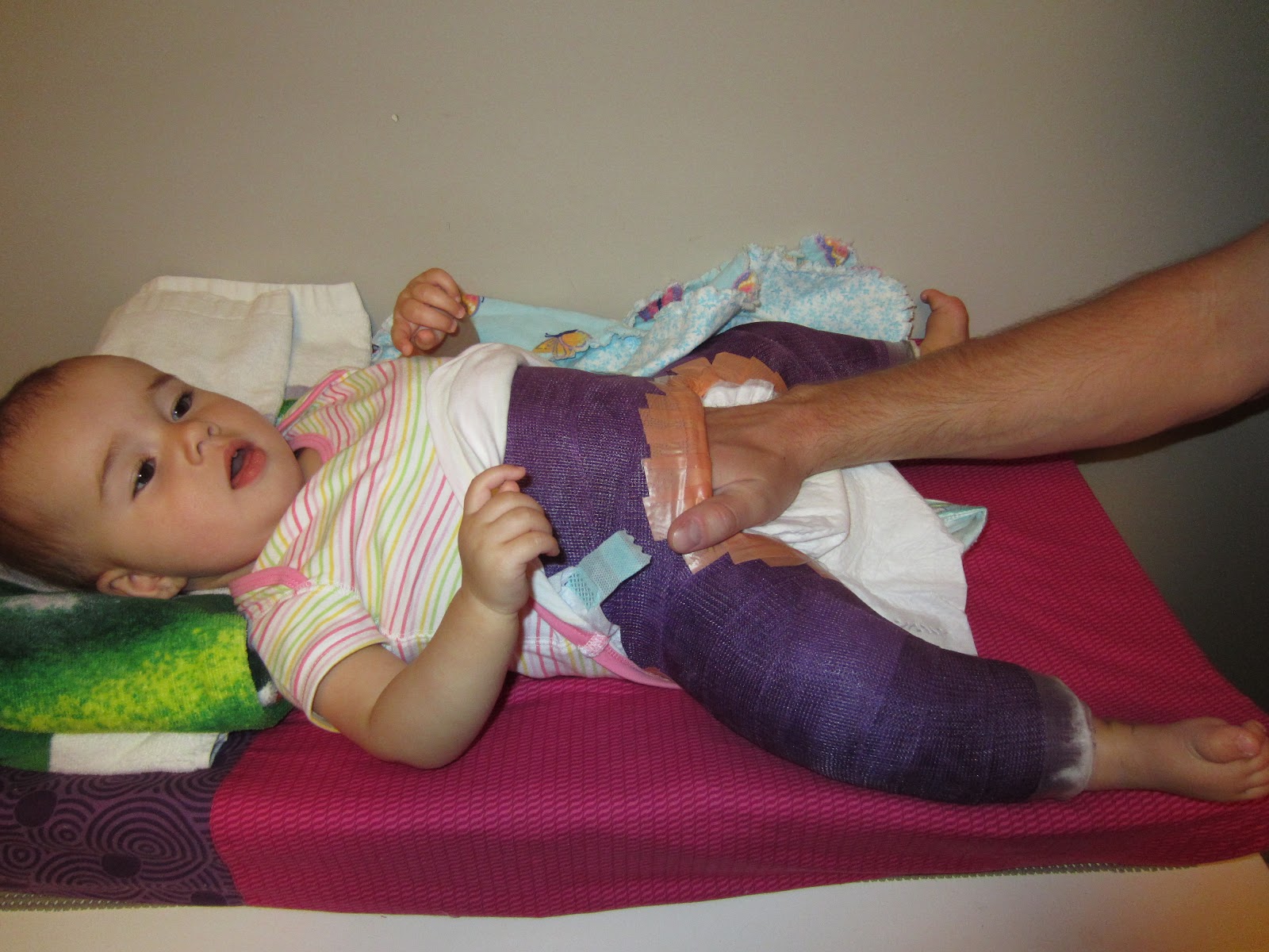 Mackenzie's Hip Adventures Diapering in the Spica Cast