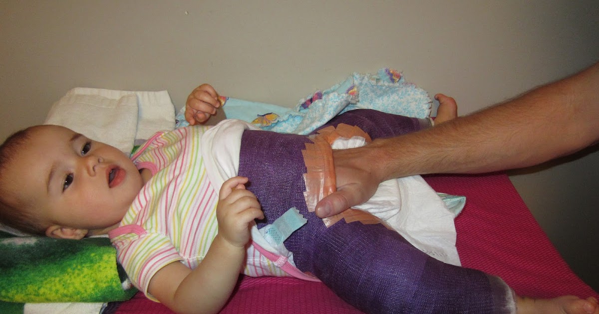 Mackenzie's Hip Adventures Diapering in the Spica Cast