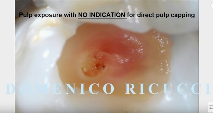 Deep CARIES with clinical pulp exposure - Dr. Domenico Ricucci