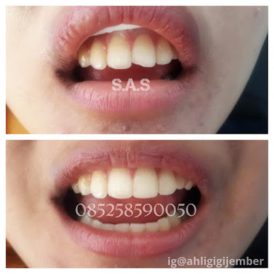 foto tambal gigi sebelum dan sesudah