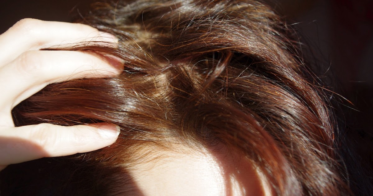 Greasy Hair Even After Washing? Might Be Seborrheic Dermatitis
