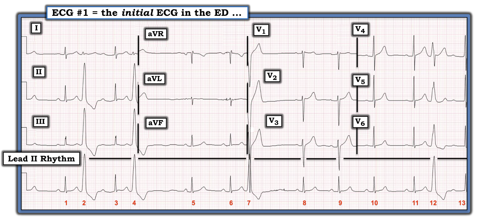 Dr. Smith's ECG Blog PVCs and AV Block in a Young Adult?