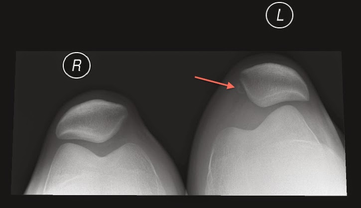 Elmslie-trillat operation (2 års tillbakablick) | Österbottningen