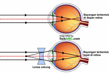 Cacat mata yang tidak dapat melihat benda yang jaraknya dekat adalah