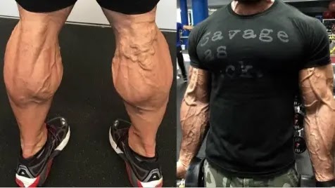 stretch marks from bodybuilding stretch marks from bodybuilding
