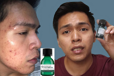 mengobati Jerawat Dengan minyak pohon teh