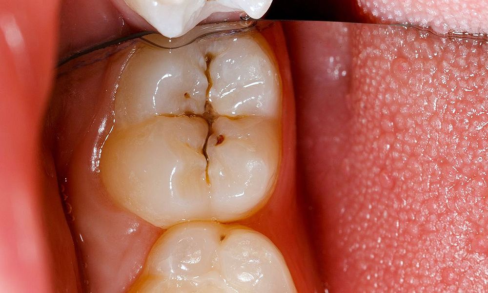 Can a cavity spread from one tooth to another tooth